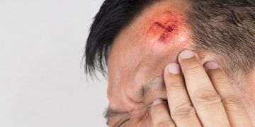 Physiotherapy’s role in the asessment and treatment of concussion in New Zealand